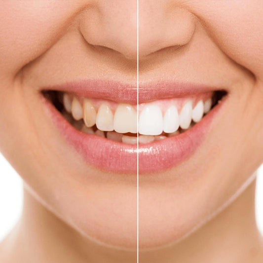 SPI Styles Teeth Whitening Kit LED - Home System for Whiter Teeth 3 Pens SAFE (SOLD OUT) - SPI Styles
